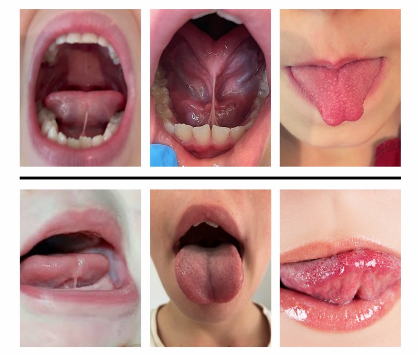 Cắt thắng lưỡi cho trẻ nhỏ có cần thiết không? Hiểu đúng và đủ – BS Đức Nha Trang
